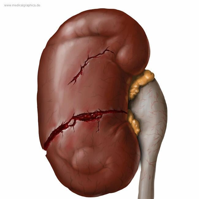 Nierenruptur / kidney rupture