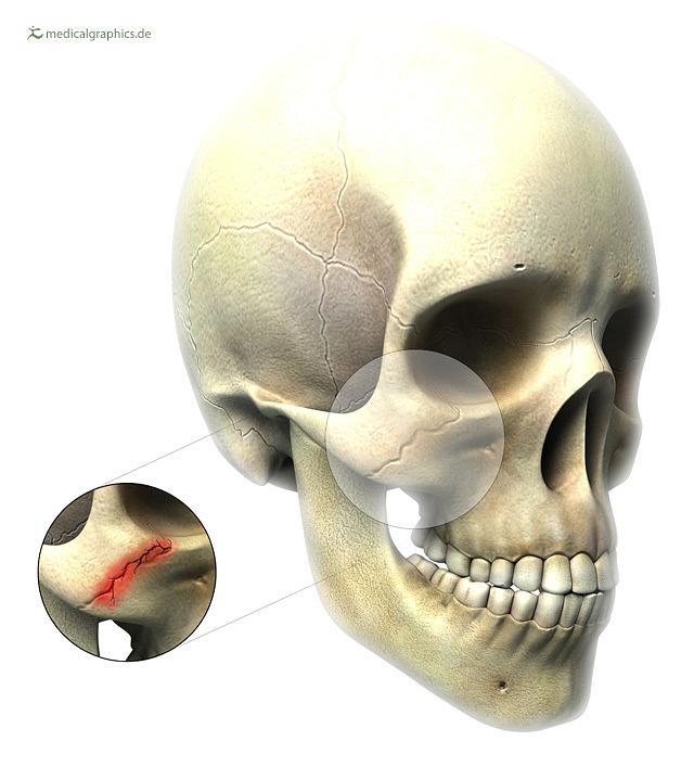 Illustration Jochbeinfraktur / cheekbone fracture